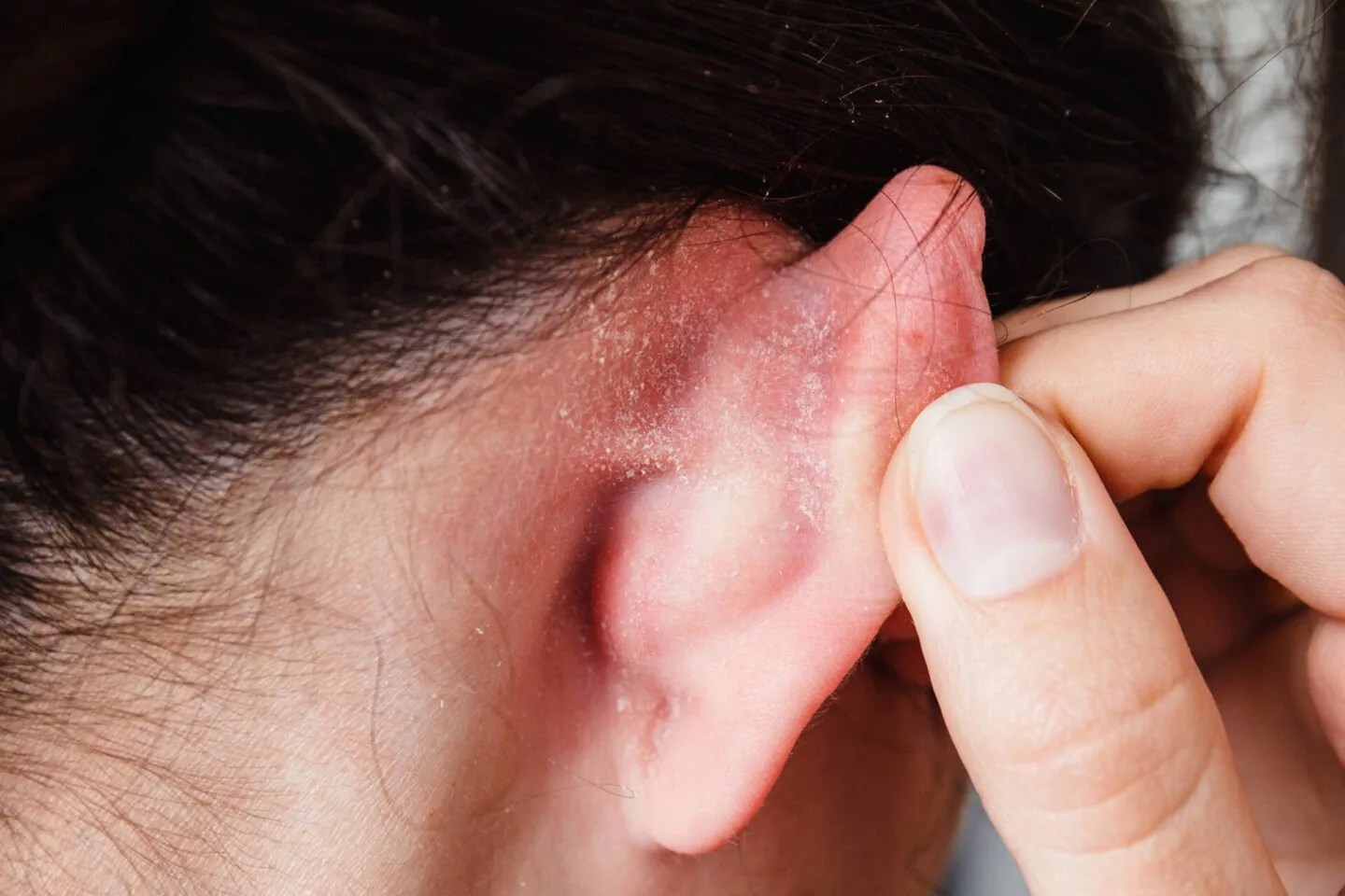 How To Get Rid Of Pimples Behind The Ears [Bye Ear Acne]