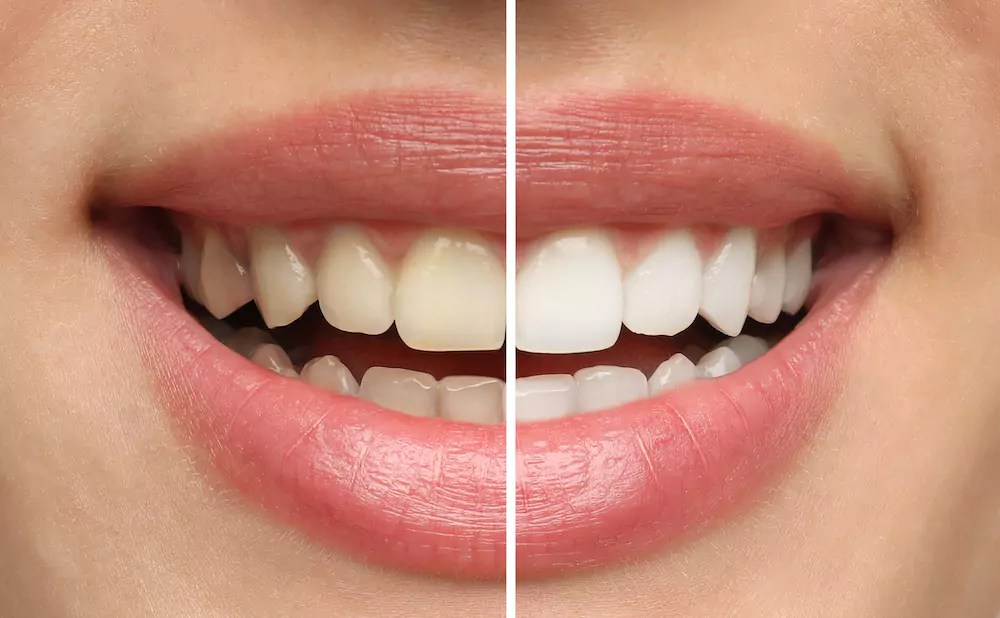How Long Does Teeth Whitening Last? Professional vs. DIY