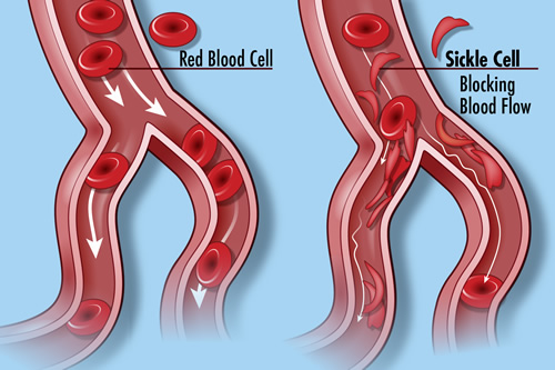 New NIH studies seek adults and families affected by sickle cell