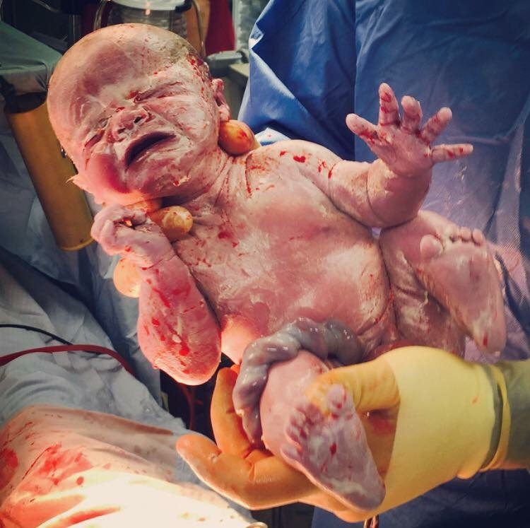 Csection birth stories • Gestational Diabetes UK