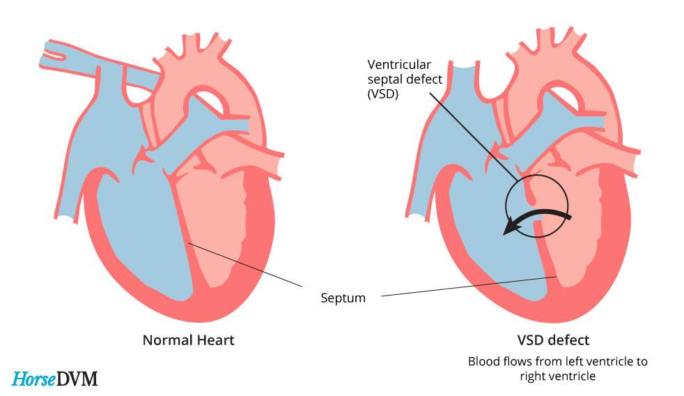 A Hole in the Heart? Ventricular Septal Defects GetDoc