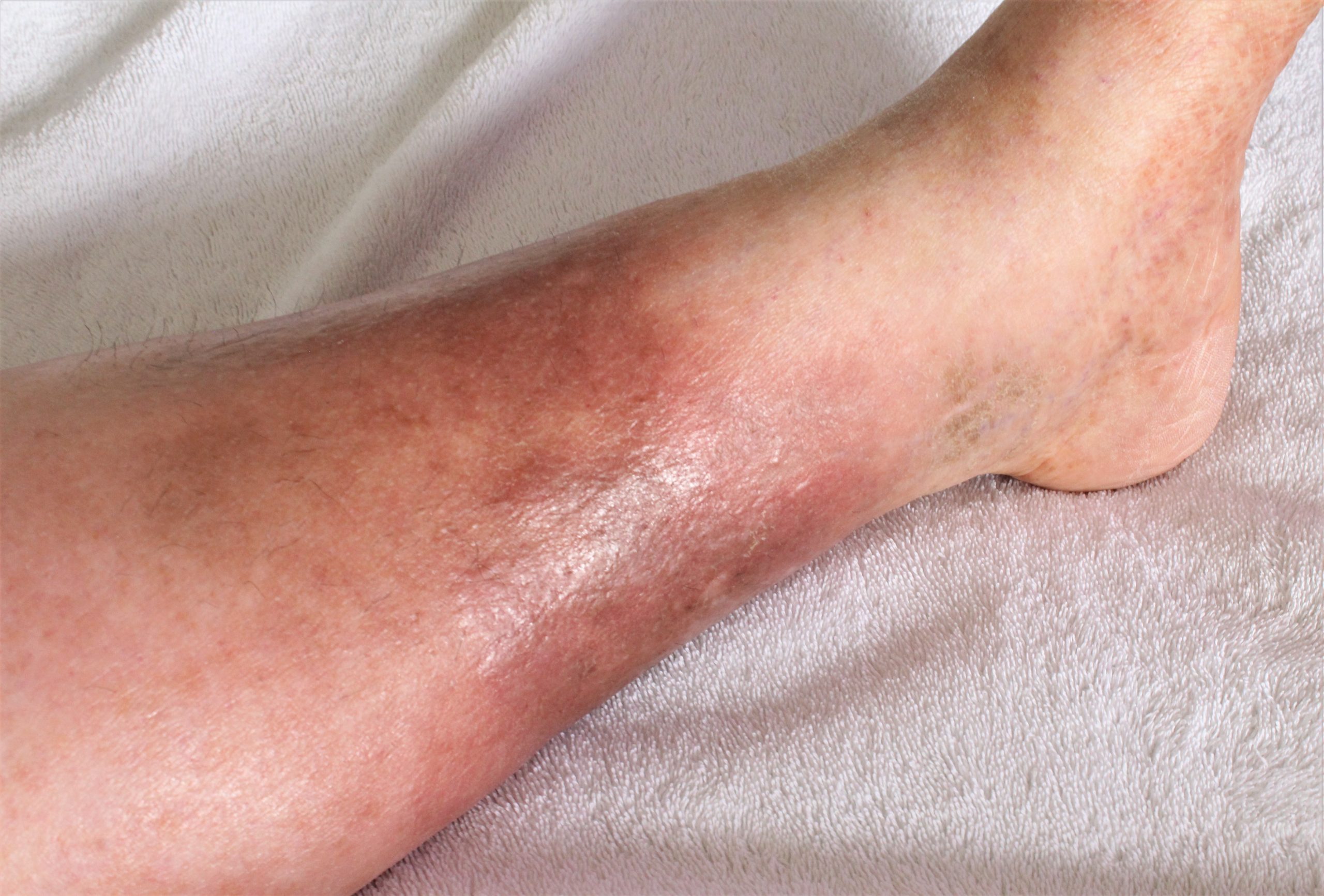 Deep Vein Recanalization for the Treatment of Post Thrombotic Syndrome