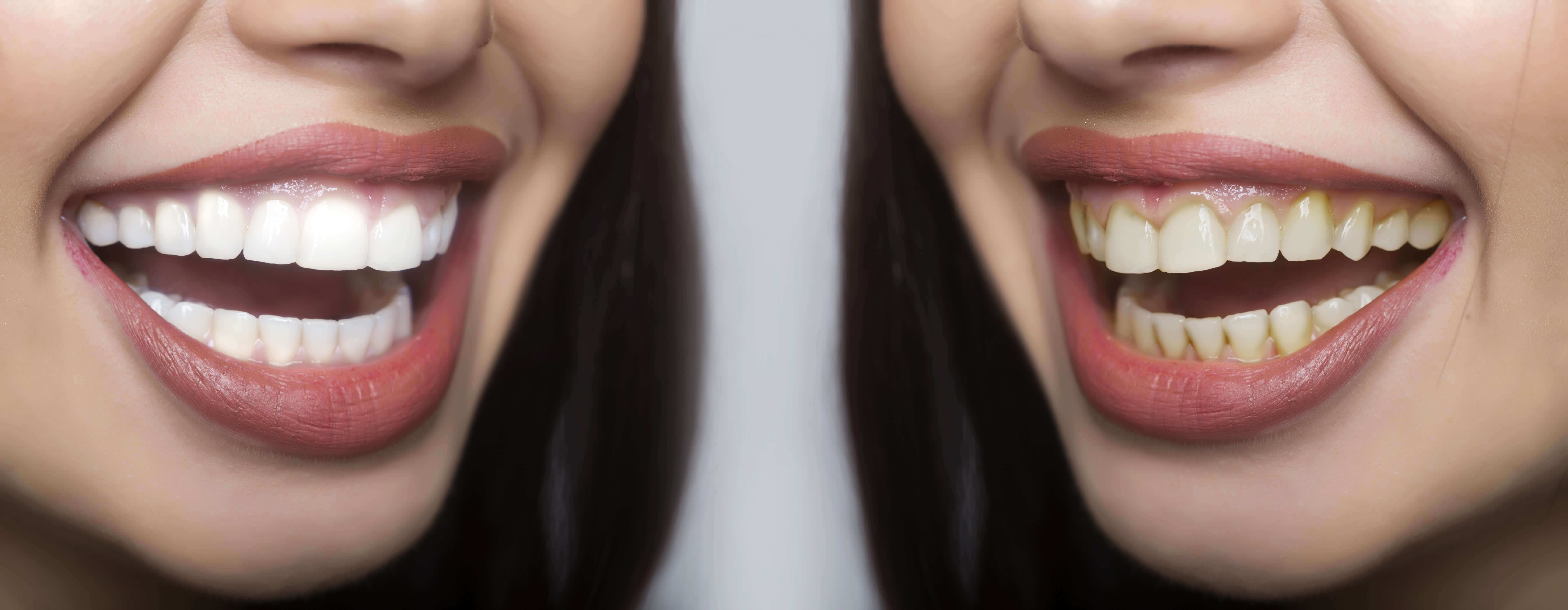 Top 10 Ways to Whiten Your Teeth at Home Get That Right