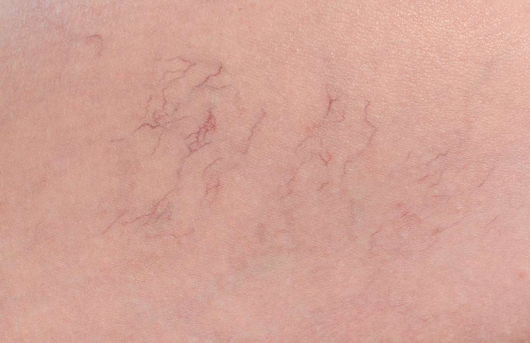 5 Things You Need To Know About Spider Veins Grand Junction Vein Center