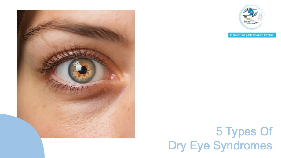 5 Types Of Dry Eye Syndromes Malaysia