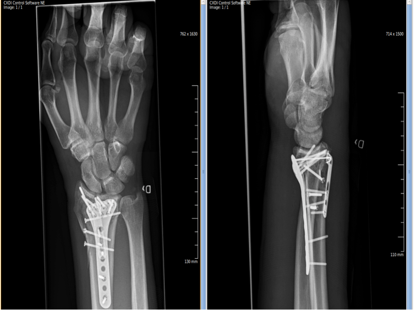 Wrist Fracture Surgery GlobeHealer