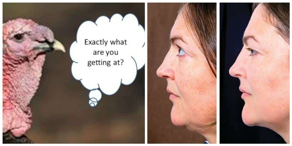 How to Get Rid of TURKEY NECK without Surgery?