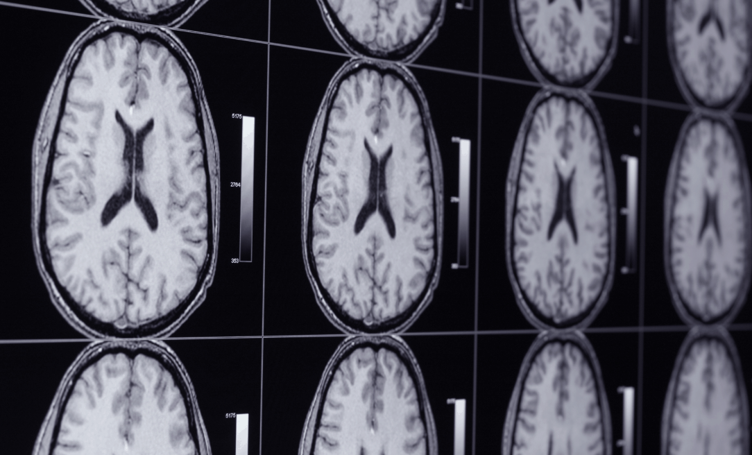 Are Food Allergies Affecting Your Brain Part 1? GlutenFree Society