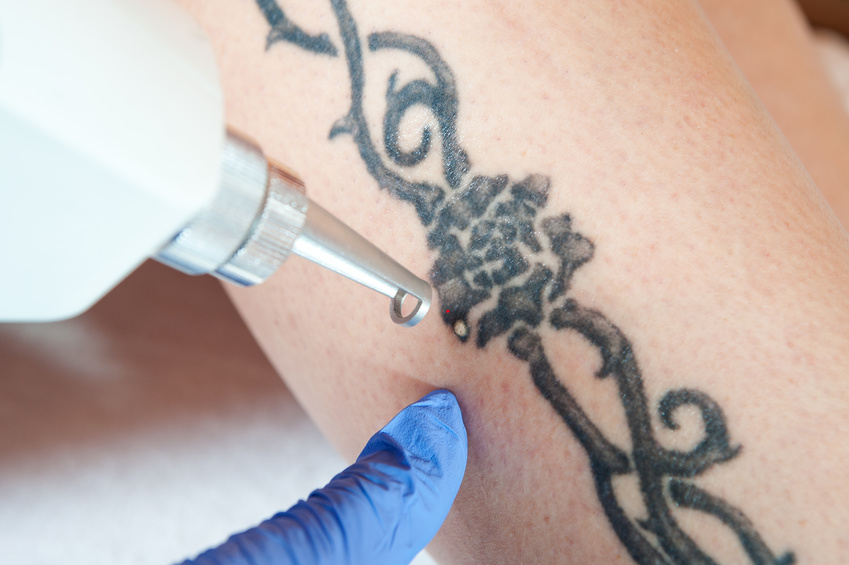 3 Important Things You Should Do After a Laser Tattoo Removal Procedure