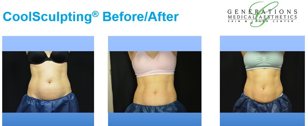 CoolSculpting Reston Fat Reduction Treatment Northern VA GMA Laser