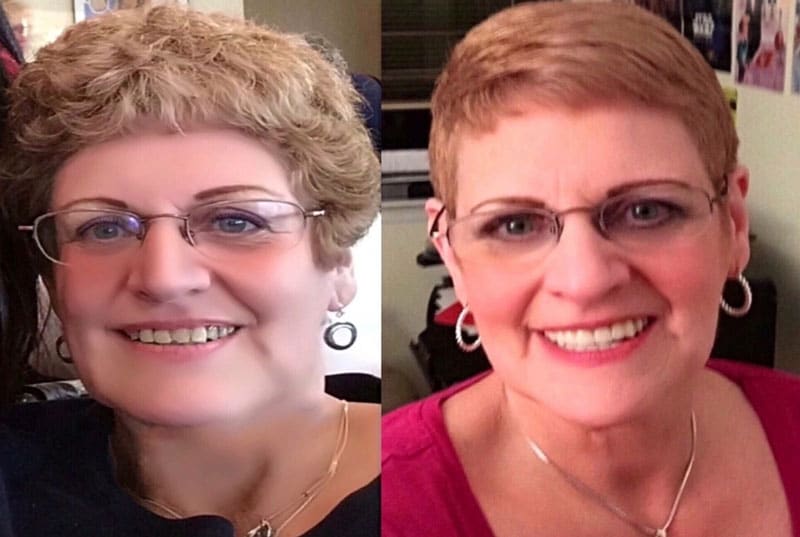 Implant Supported Dentures Gold Coast Smiles Glen Cove, NY