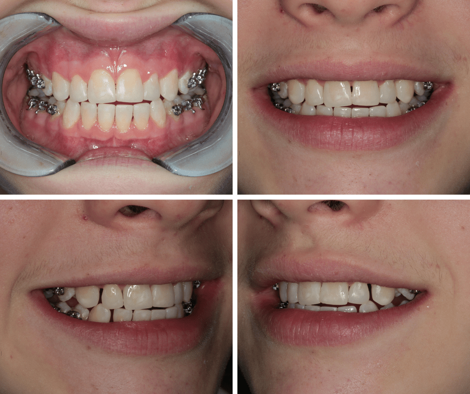 Ectodermal Dysplasia Teeth