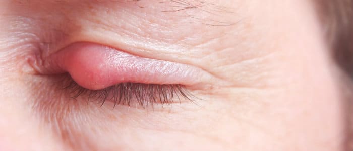Eyelid Pain: 5 Reasons Eyelids Hurt & How To Soothe Eyelid Irritation
