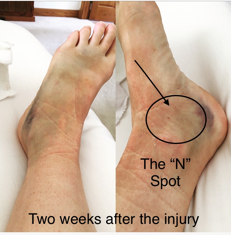 Nursing a Navicular and Talar Head Fracture GOOD MOXIE