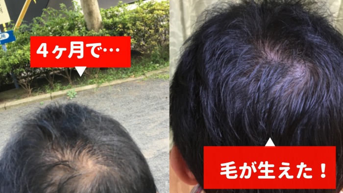 監修記事】「生え際後退」と「おでこが広い」の違いは？薄毛の原因と対策方法 | 髪コト - 頭髪を通じてライフスタイルを豊かにするための情報を発信 ハゲ薄毛の悩みをローコストで解決した！45歳の僕が試したAga治療法の内容を公開する｜50 Garege