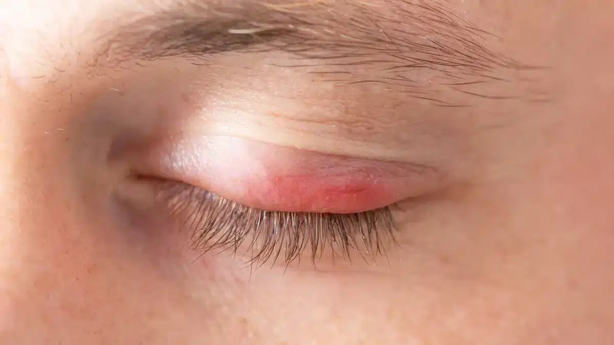 Explaining The Various Causes of Eye Swollen and Red
