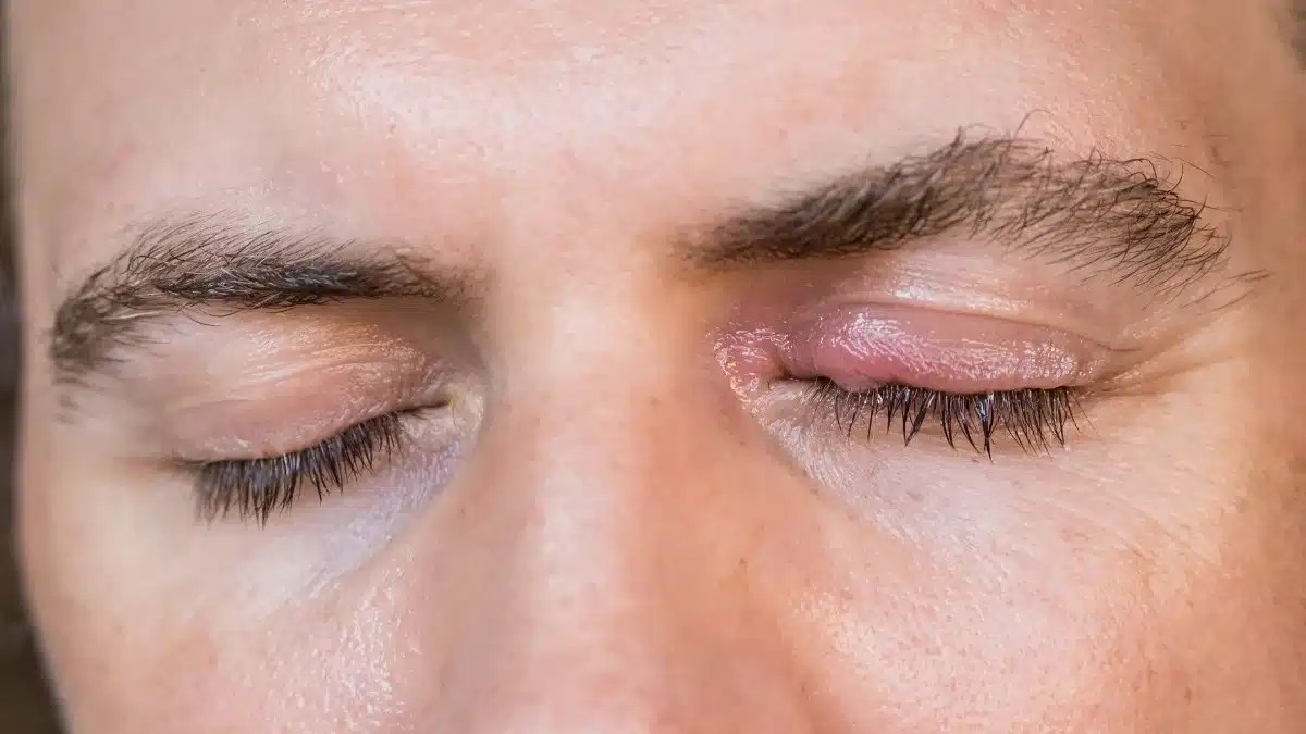 Why is My Eye Swollen Understanding the Causes