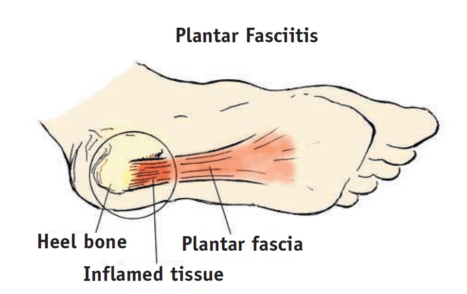 AtHome Treatments for Plantar Fasciitis AtHome Treatments for Plantar Fasciitis