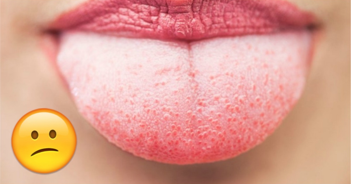 Have a WHITE TONGUE? Here's what your body is trying to tell you