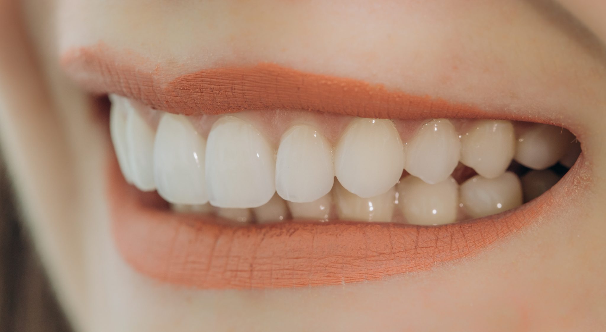 How long do permanent veneers last? Graceful Smiles