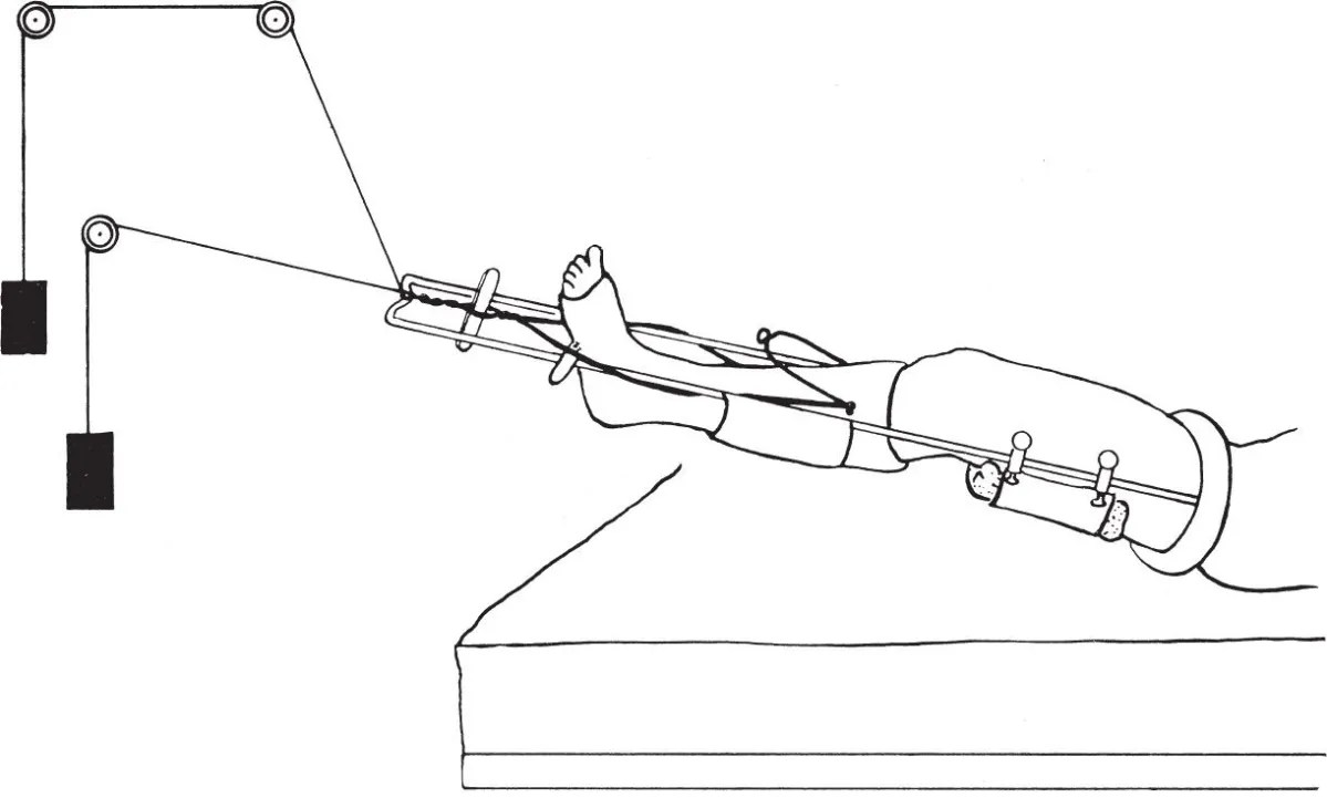 Skeletal Traction