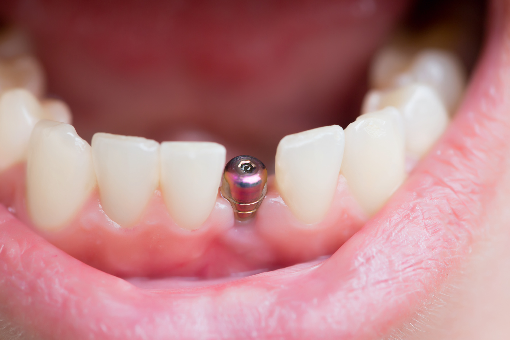 Implants dentaires Groupe Dentaire Laval