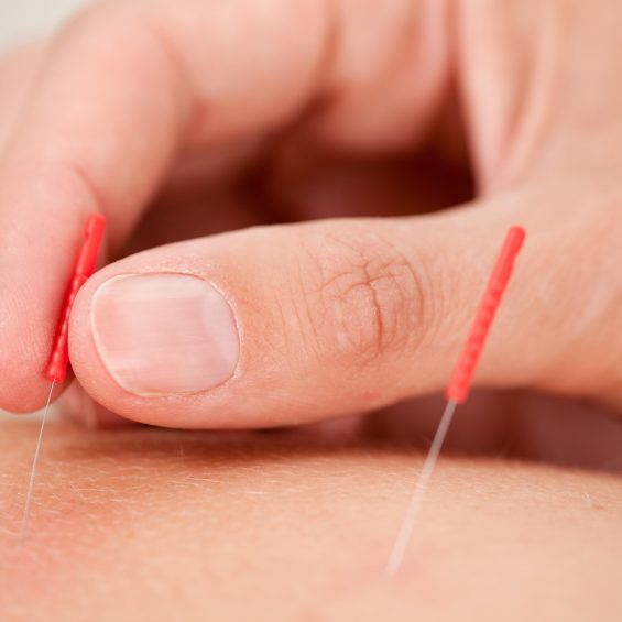 Dry Needling Growing Bones