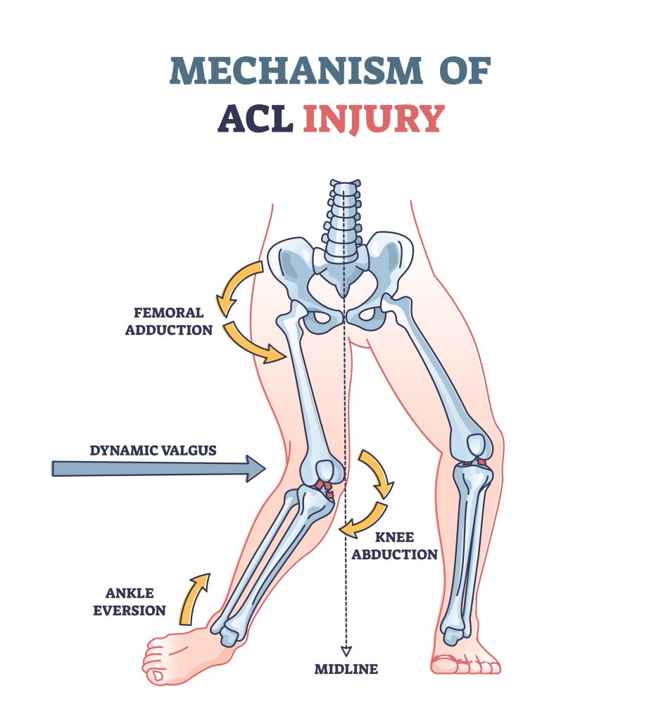 ACL vs. PCL GulfPhysio UAE's Online Physiotherapy Store