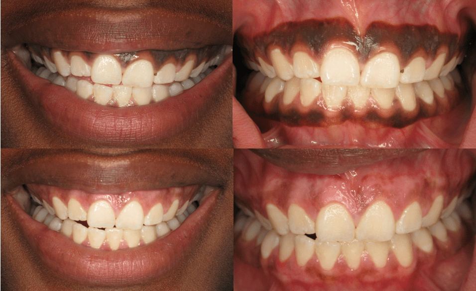 How To Get Pink Gums