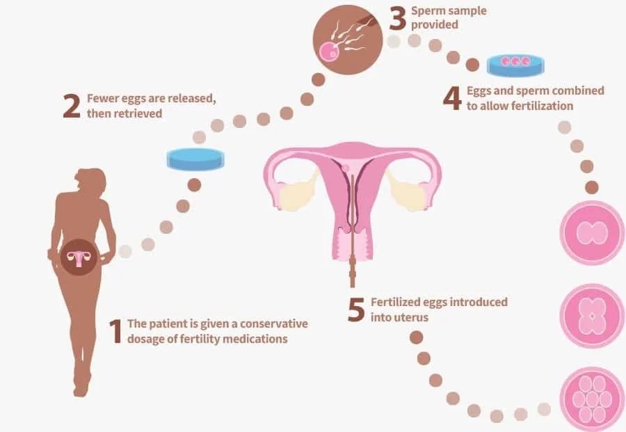 What Is Mini or Micro IVF Mini or Micro IVF Gunjan IVF World
