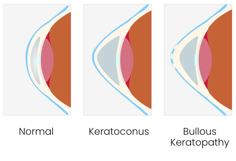 Keratoconus San Diego La Jolla CA