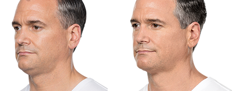 Double Chin Treatment in New York with Dr. Elliot Jacobs