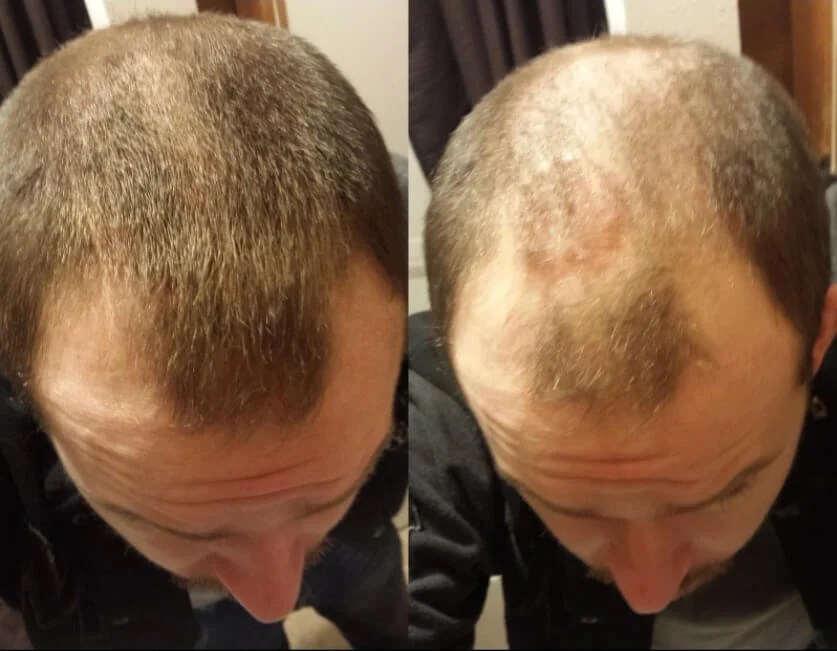Glh Hair Spray Side Effects Captions Viral Today