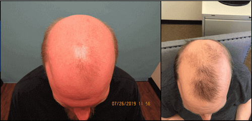 Exosome Before and After Photos McGrath Medical Hair Loss Cure 2020