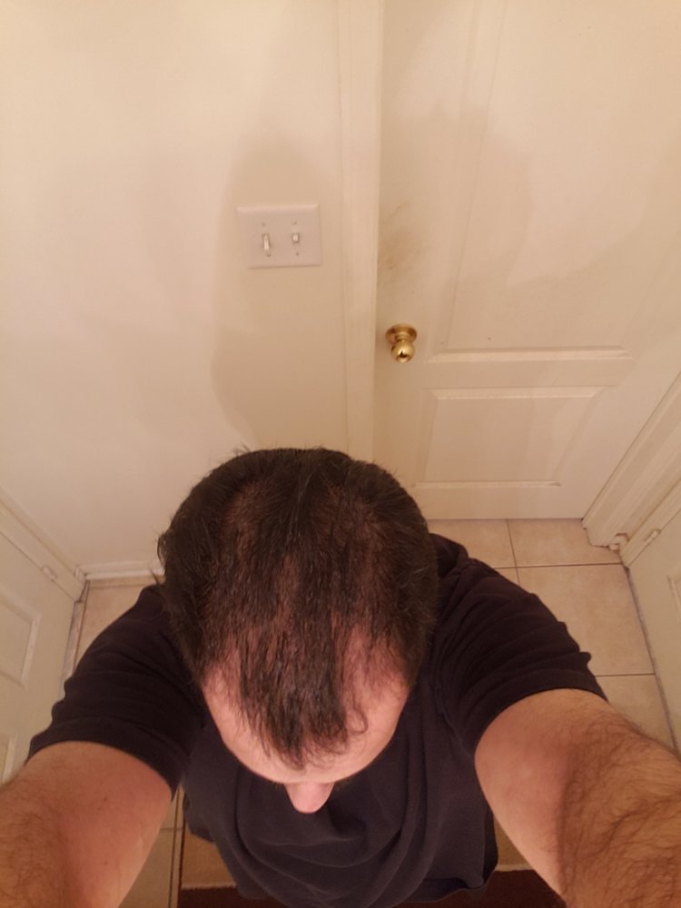 11 Does Hair Loss From Mold Grow Back 2022