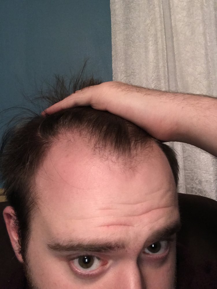 24 Y/o Can’t Tell If It’s A Mature Hairline Or A Receding Hairline