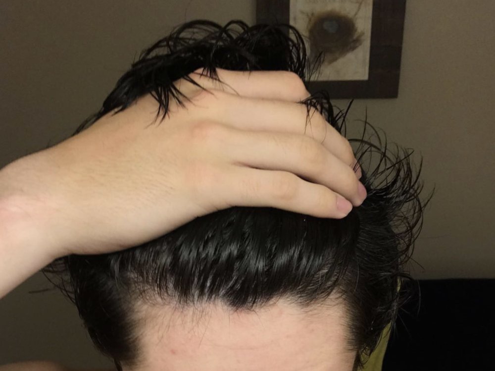 [update] Anyone See A Concerning Pattern In My Hairline? HairLossTalk