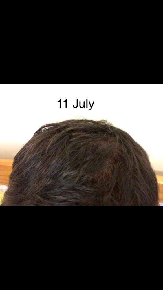 Can Telogen Effluvium Cause Hairline Recession