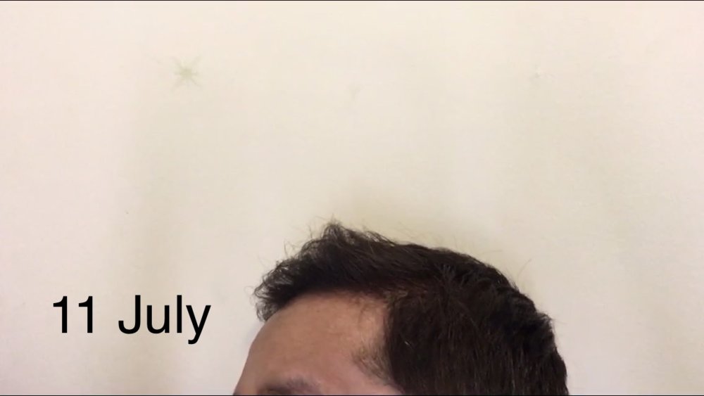 Can Telogen Effluvium Cause Hairline Recession