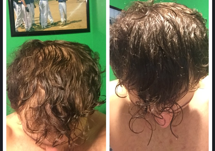 Wet Hair On Minoxidil | Hairlosstalk Forums
