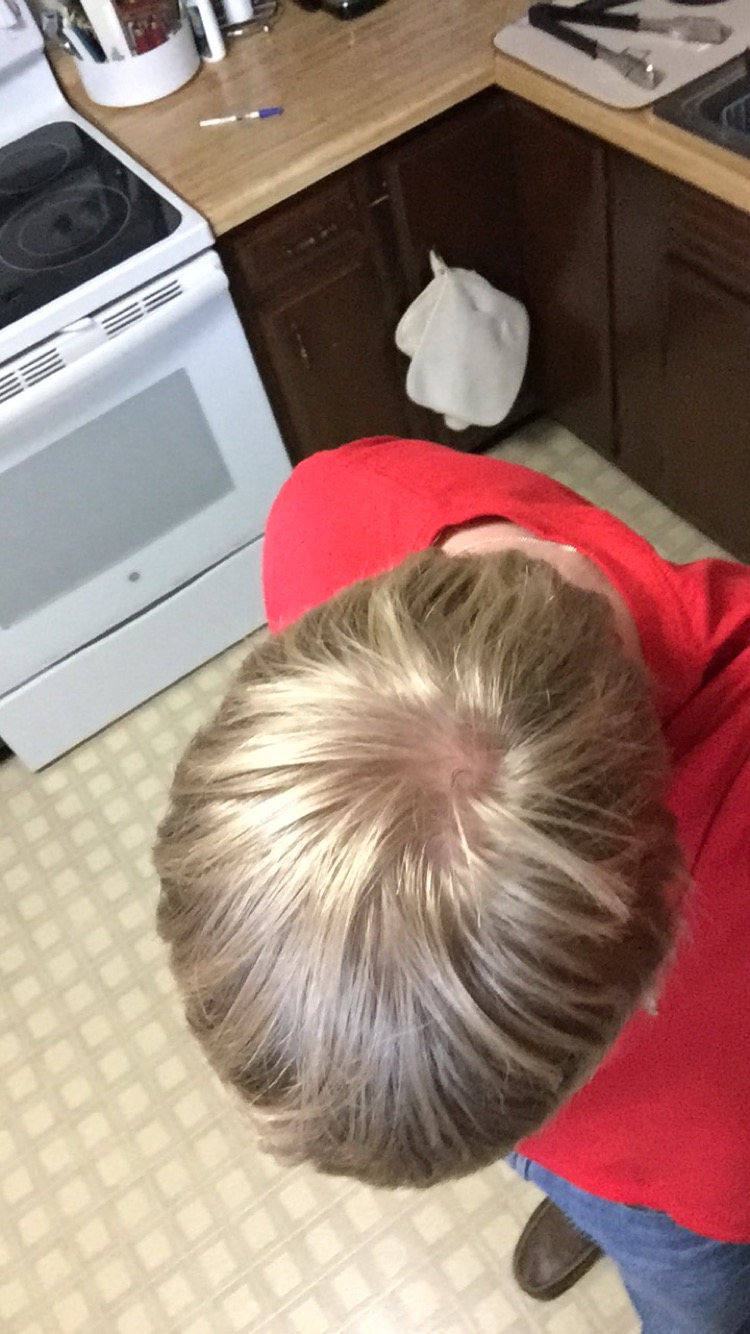 Cowlick/whorl, Or male pattern baldness? HairLossTalk Forums