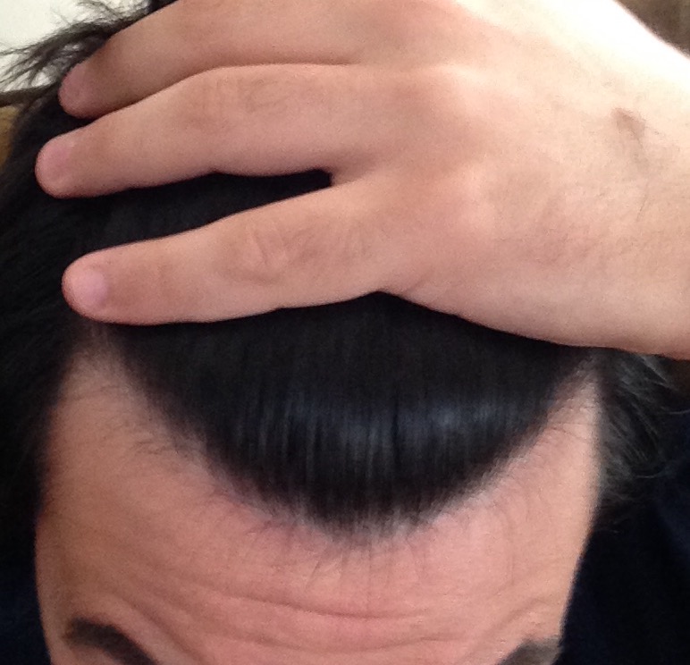 Am I Going Bald? 18 Year Old Male Norwood 2 HairLossTalk