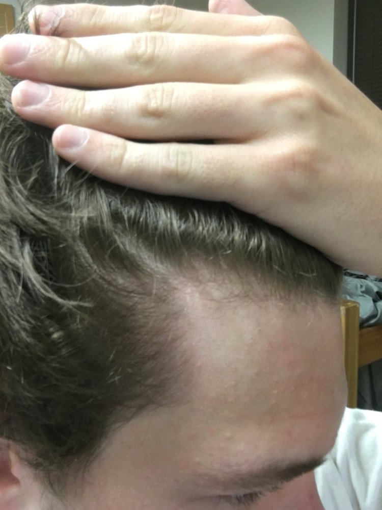 19 Year Old Need Thinning Hair Advice HairLossTalk Forums