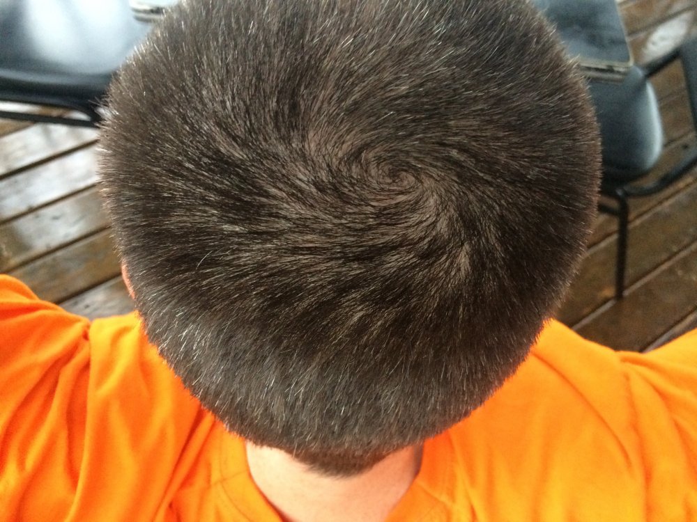 Help! Accelerated Frontal Thinning Due Propecia 4 Months