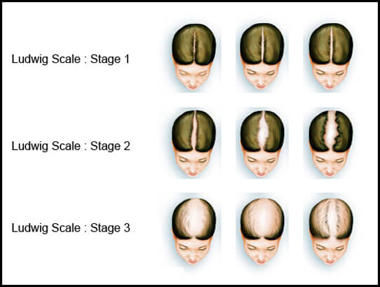 Incredible Ludwig Scale Hair Loss 2022