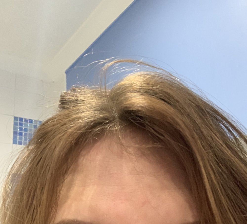 Can Someone Please Advise Me Hair Loss/thinning