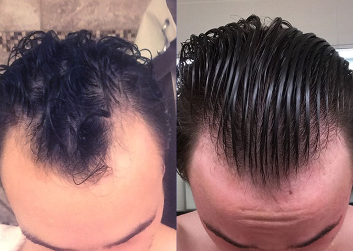 Metformin Hair Loss Hair Loss Associated With Metformin Diabetes