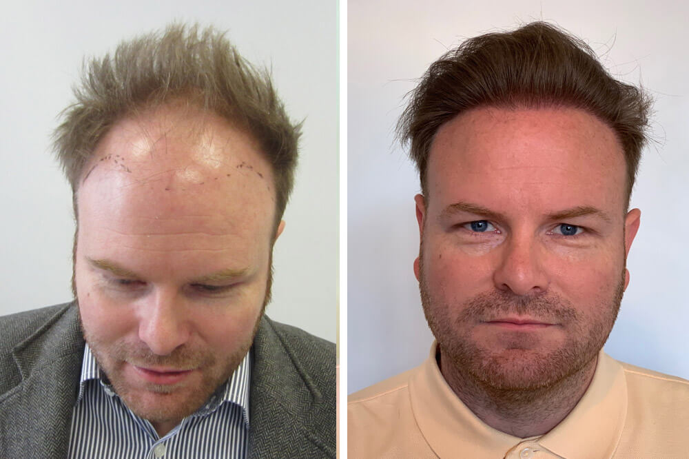 shortdarkhair Hair Transplant Surgery For Men