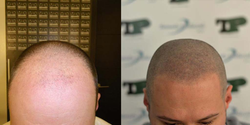 Scalp Micropigmentation Training Availalbe. Learn More!!!