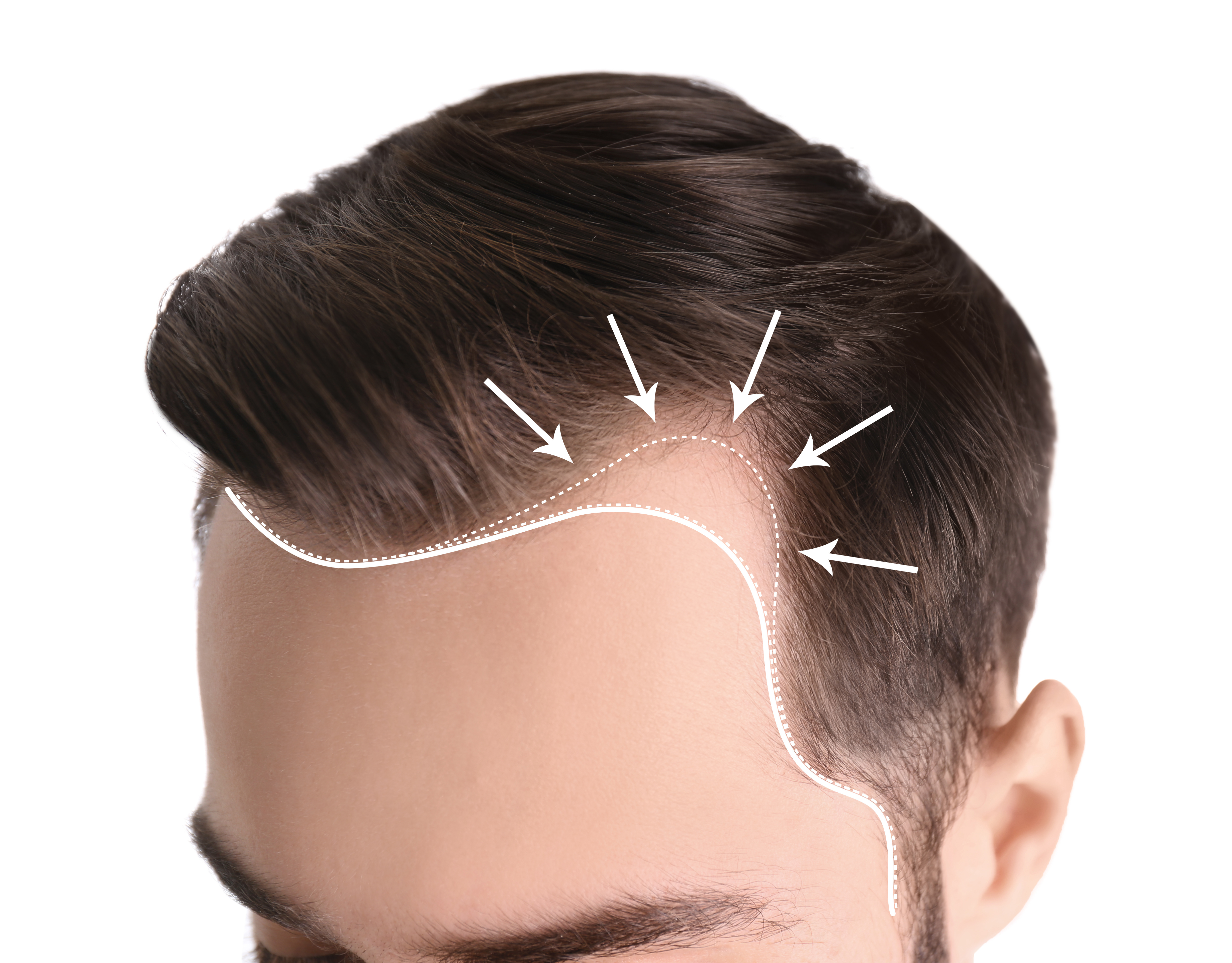 Ultimate Guide to Hair Loss Everything You Need to Know Ultimate Guide to Hair Loss Everything You Need to Know